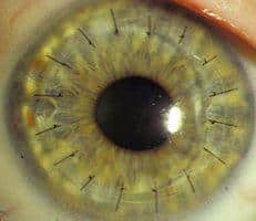 Laser Corneal Transplant Eye