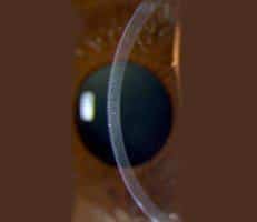 Endothelial Keratoplasty Eye