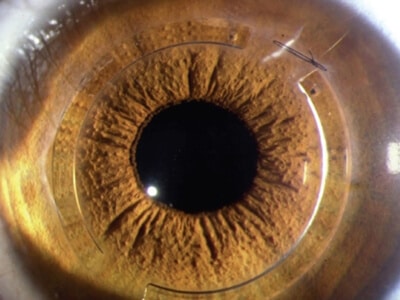 Lens in an Eye
