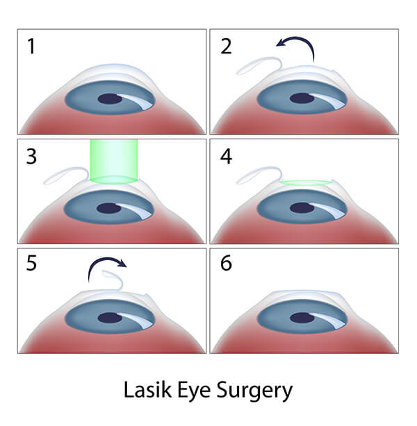 Chart Illustrating the LASIK Surgery Process