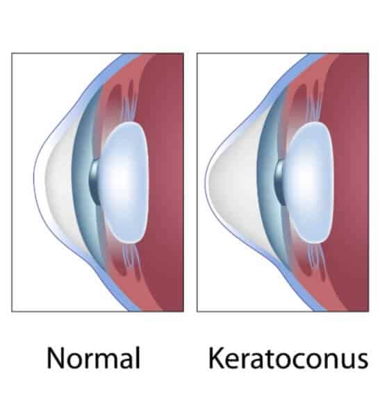 Chart Illustrating a Normal Eye Vs One Experiencing Keratoconus